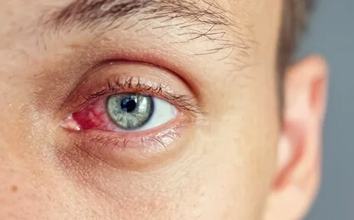 Diyabetik retinopati - kanlanmış göz görseli
